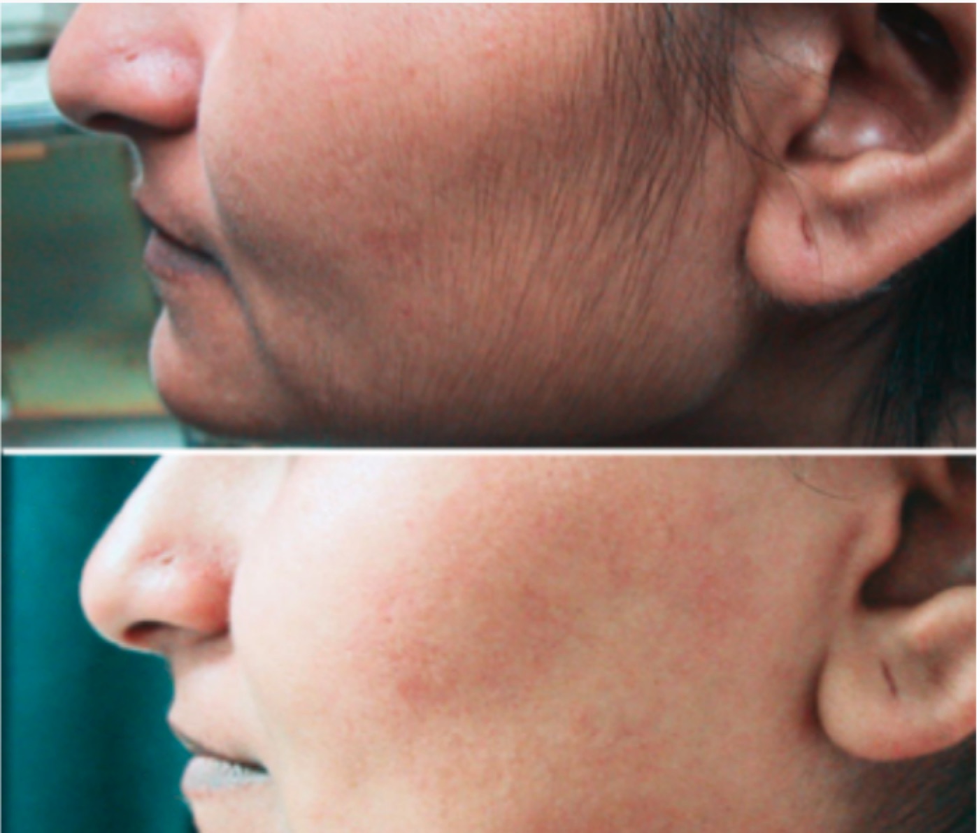 Before and after laser hair removal — chin and jawline