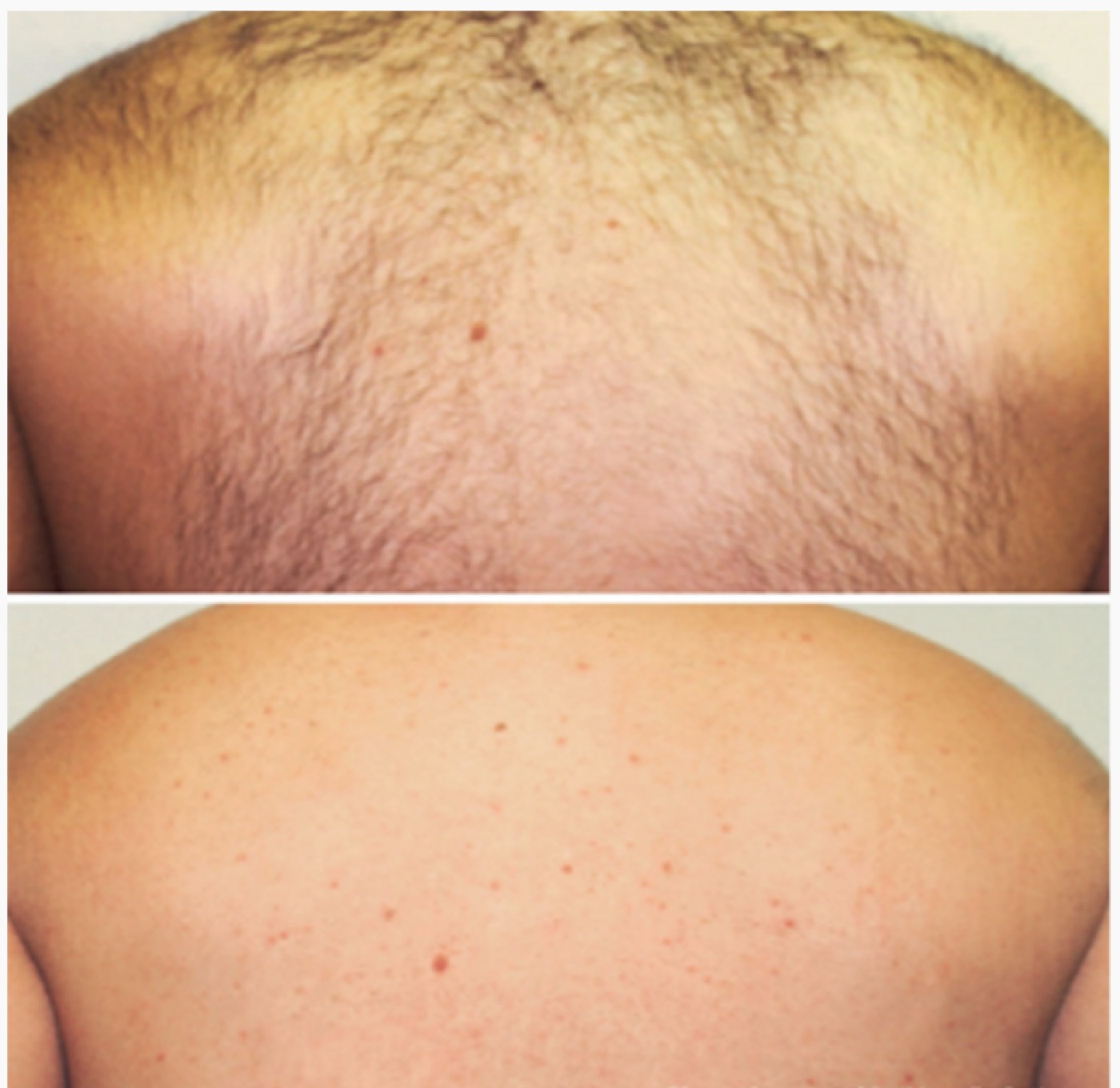 Before/after laser hair removal · nape