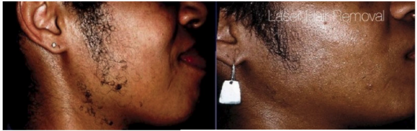 Before and after laser hair removal — face