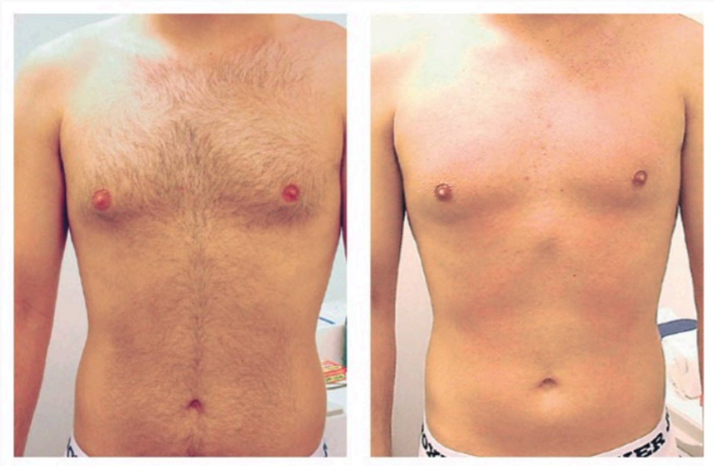Before and after laser hair removal — chest