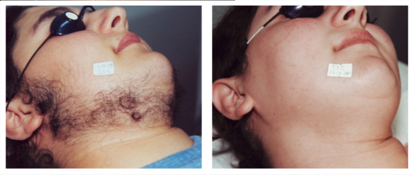 Before and after laser hair removal — beard