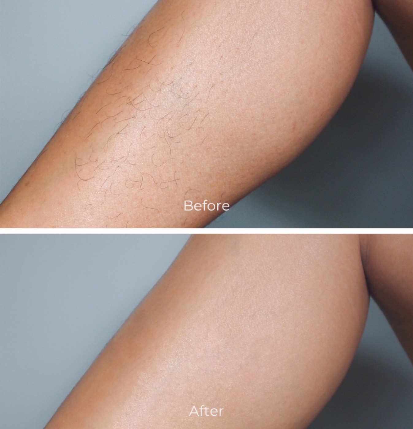 Before/after laser hair removal · legs