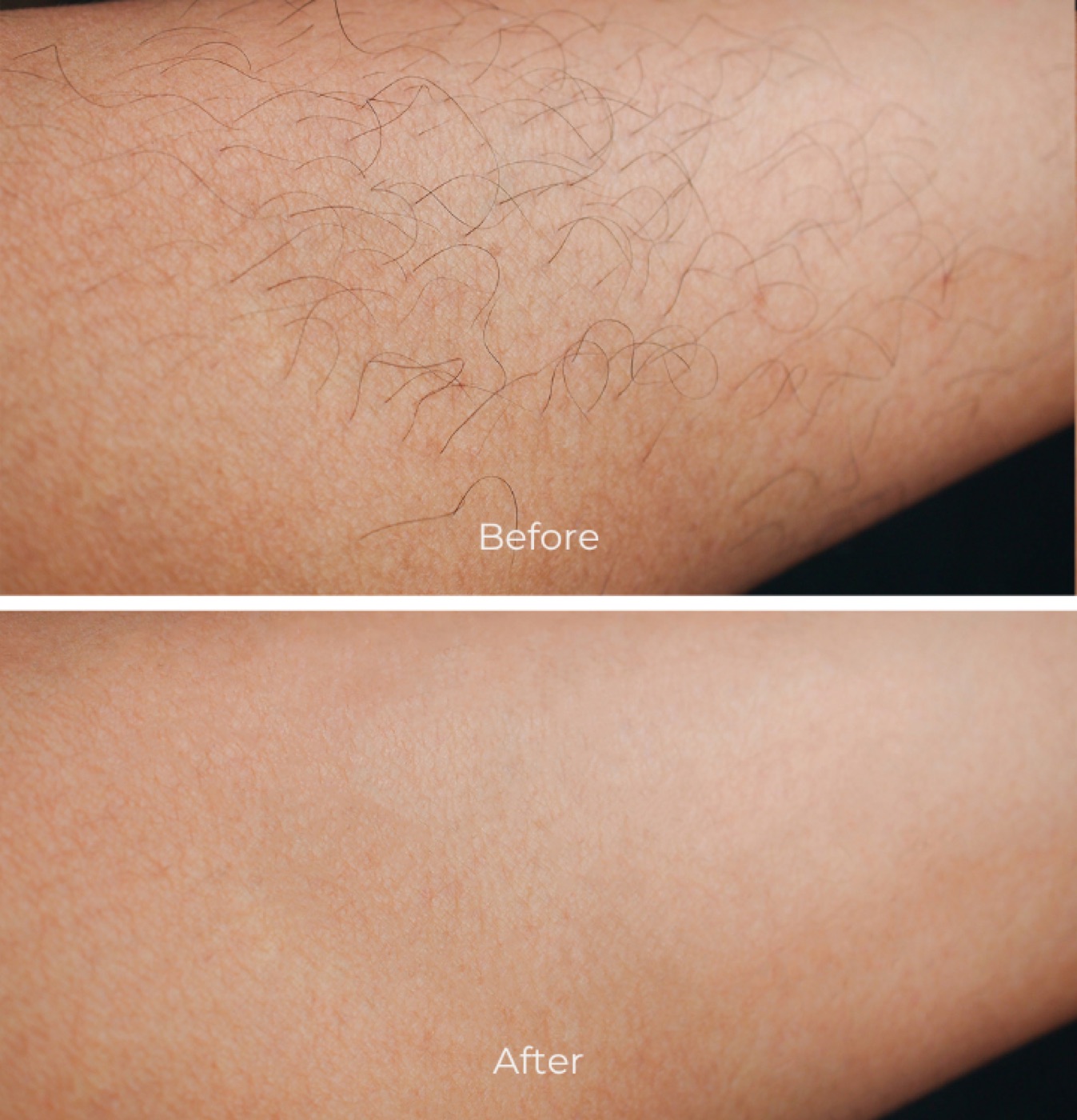 Before/after laser hair removal · arm